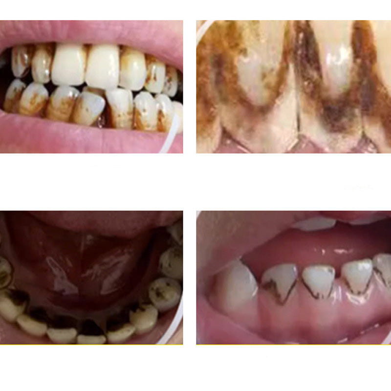 ✨😁🦷✨ Limpiador Dental Ultrasónico Portátil de Alta Eficacia - ¡Cuidado Dental 360° en Casa! 🚿🦷🌿