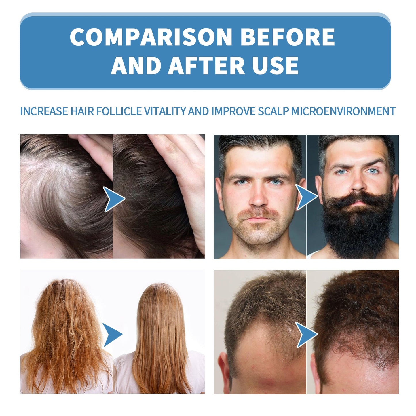 🌿EAST MOON Minoxi Roll-On Tratamiento Capilar| Compra 1, Lleva 1 Gratis 🔥